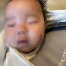 에스앤유서울병원 | [밀크반점 치료] 생후 70일 아이 에스앤유피부과 진료상담