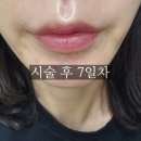 합정약국 | 합정 입술 반영구 주의사항 탈락과정까지 유주얼 일주일 리얼 후기