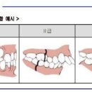 Angle씨 부정교합의 정의[상품명:무배당굿앤굿어린이치아보험(Hi2206) 1종(건강증진형 이미지