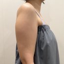 [공지] [내돈내산] 서면피부과 셀리타의원, 서면 팔뚝 얇아지는법 2회차 후기 (feat. 온다리프팅)