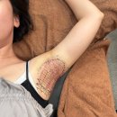 다한 | 신사역 미라드라이 후기 다한증 액취증 치료 후기