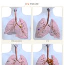 소세포폐암[small cell lung cancer] 이미지