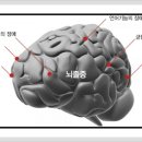 뇌출혈 증상 치료법 이미지
