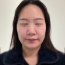 한국산소 | 일곡동 에끌라 영 에스테틱, 오투덤 산소테라피 만족 후기(편사제거 후 관리)