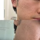 강남한의원 | [여드름흉터치료] 강남한의원 새살침 내돈내산 후기✨(가격,원리,부작용)
