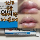 임산부 입술 헤르페스 포진 후기 (아시클로버 연고 바이버 크림)