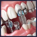 부천청담네오플란트치과의원 이미지