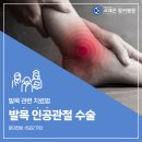 송파 인공관절수술병원의 발목 인공관절 수술 이미지