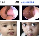 오세미한의원 | 한방 비염치료 치료약에 대해 궁금하신분!