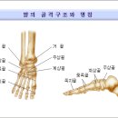 발의 골절 이미지
