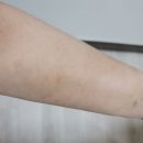 위드유이비인후과의원 | 아토피병원, 양재아토피병원, 위드유 의원 3개월 차 아토피 탈출 후기