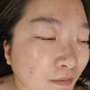 보라매피부관리 숲칼프 보라매아카데미점 만족스러운 여드름관리 후기