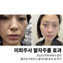 미희네 | 연신내피부과 미희주사 팔자 후기 효과