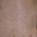 매그넘의원 | 부산스킨보톡스 솔직후기(전후 비교)