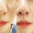 청담비엘의원 | 팔자 주름 없애기 무통증 팔자 필러 후기