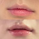대전더마스터의원 | 바노바기의원 대전 입술필러 비포애프터 솔직 후기