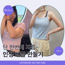 스카이라인의원 | 인천지방흡입잘하는곳 스카이라인의원 부평지방흡입 대용량 종아리+팔 후기