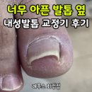 동원텔약국 | 덕양구 레푸스) 내성발톱 교정 통증없을까? 레푸스 내성발톱 교정 1회 후기