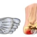 "타이거우즈도 절게 한 '족저근막염'…생활 속 원인 찾아야 이미지