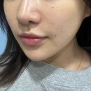 분당 서현 모공타이트닝에 효과적인 알에프포샵 RF4# 후기