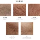 청산한의원 | 수원 영통역 한의원 여드름패인흉터 새살침 치료 후기