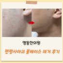 김한의원 | 얼굴편평사마귀성지 명동한의원에서 풀페이스 제거하고온 후기