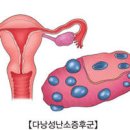 다낭성 난소 증후군 증상과 원인 치료 방법 임신할 수 있을까? 이미지