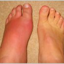 신통한성모마취통증의학과의원 | 통풍발작 신경차단술로 즉시 통증 사라짐