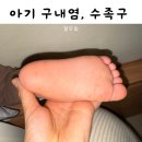 수족구 구내염 초기 증상 발병 증세 보험 청구 및 아이 상태 공유