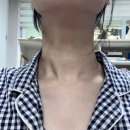 편평 사마귀 제거 과정 (6) : 한 달 경과 후기