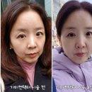 [공지] 강남역 피부관리 기미컨택터 엑소좀 스킨부스터 첫 손주사 효과 비용 통증 후기