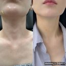 여*진 - 미추홀구 남주길 150 | 신사역피부과에서 목주름지우개로 쫙펴고 피부나이 5살 젊어진 후기