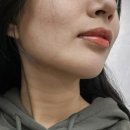 화곡역 피부과 리프팅 관리는 볼뉴머 300샷으로