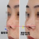 들창코 | 들창코수술, 콧구멍이 많이 보인다면? 짧은코수술 가격