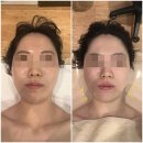 라보떼 헤어(Labeaute Hair) | 방문 후기 : 대연동피부관리 라보떼에스테틱 싸이블로리프팅 3000샷 + X모드 후기💡 / 대연동에스테틱...