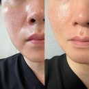 네오의원 | 강남 벨뷰의원 물방울리프팅 제네시스 네오빔 2주 후기와 홍조는?