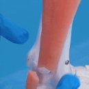 아킬레스건 파열 치료 방법 이미지