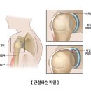 관절와순 파열 (Labral tear) 근골격 질환이란? 이미지