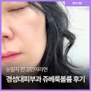 경성대피부과 쥬베룩볼륨 2주 차 후기 팔자 볼 눈밑지 고민 해결