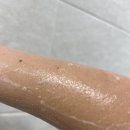 피부발진 가려움 9일만에 해결