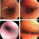 흉부 견축1 chest retraction 이미지