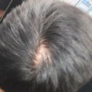 고려약국 | 로게인폼 약국 직구 방법 및 부작용 효과 극복 후기