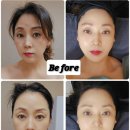 세포마을 | 성수 피부관리 &amp; 얼굴윤곽관리 후기(미백, 주름, 줄기세포 리프팅)
