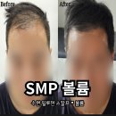 볼륨 / 수원 SMP 두피채움 정수리커버 탈모 헤어라인 리터치 솔직후기