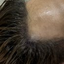 채움정형외과의원 | 클라스웰이 추구하는 자연스런 두피문신이란~?