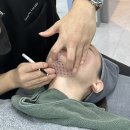 라인2차 | 중구피부과 추천 리니어지 + 브이올렛 주사 이중턱라인 2차 후기