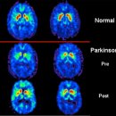 파킨슨병의 확진을 위해서 DaTscan 혹은 PET scan을 해야 합니까? 이미지