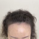 아빗 | 판교탈모관리 아빗에서 만나는 나만의 두피 시술 안내