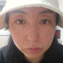 서울비뇨기과의원 | 선릉 힐비뇨기과의원 잡티제거 후기 (주차/비용/시술)