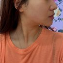 수원 세모아의원 티타늄리프팅 40kj 레이저리프팅 후기